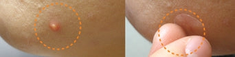CNP Laboratory Anti-blemish Spot Patch (5 ea) from Korea_MA