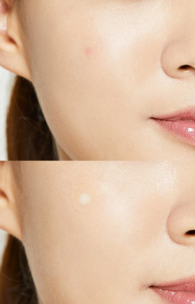 3 x COSRX Acne Pimple Master Patch 24patches from Korea by COSRX